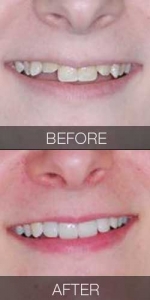 Crowding Solved with Veneers