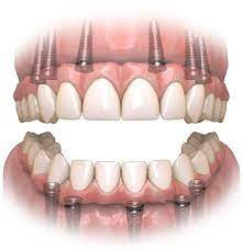 full mouth dental implants newton ma